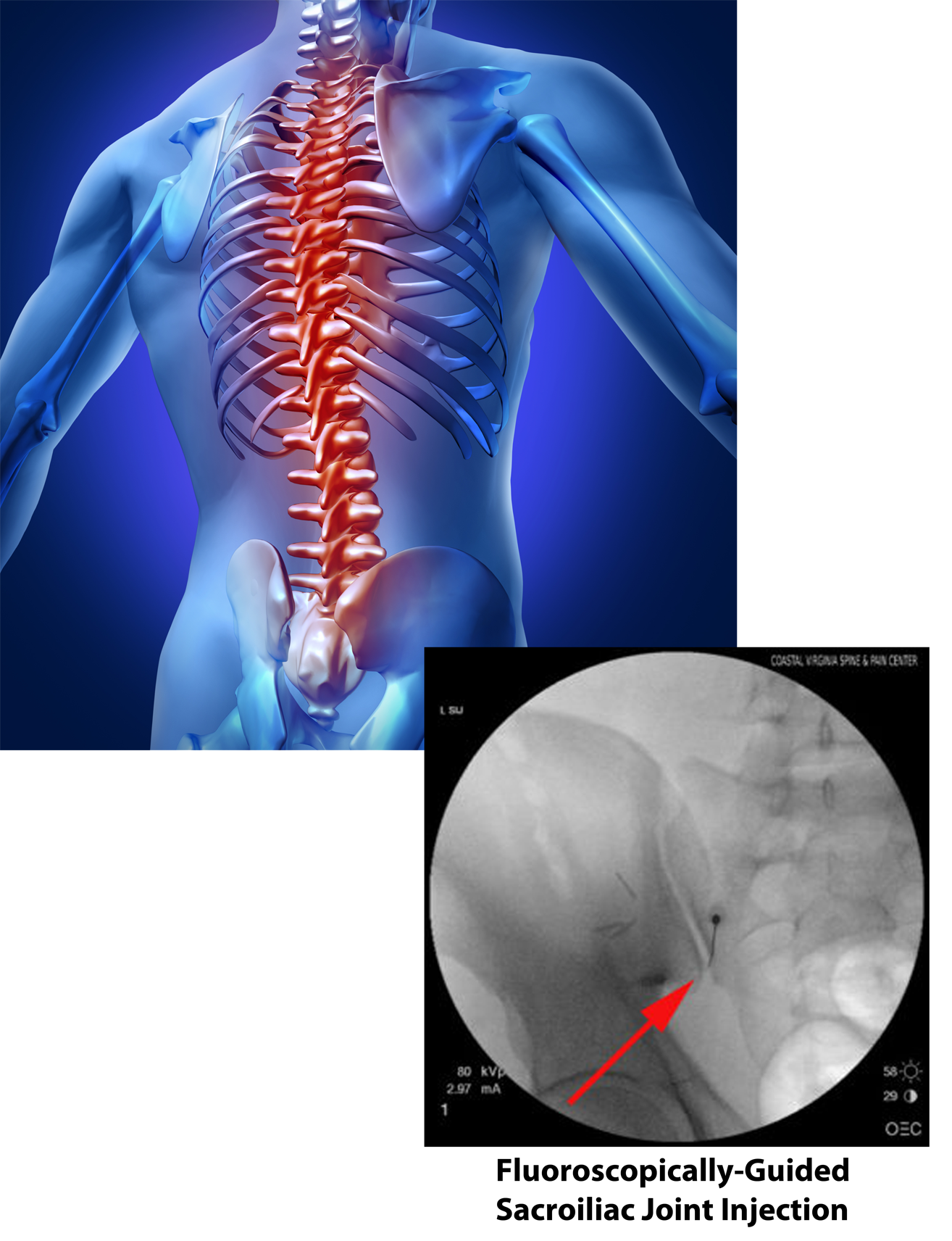 SACROILIAC JOINT DYSFUNCTION - Coastal Virginia Spine & Pain Center